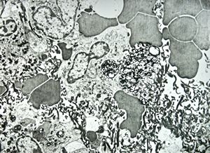 F,68y. | spleen - myelinoid inclusions - clin. susp. leukemia